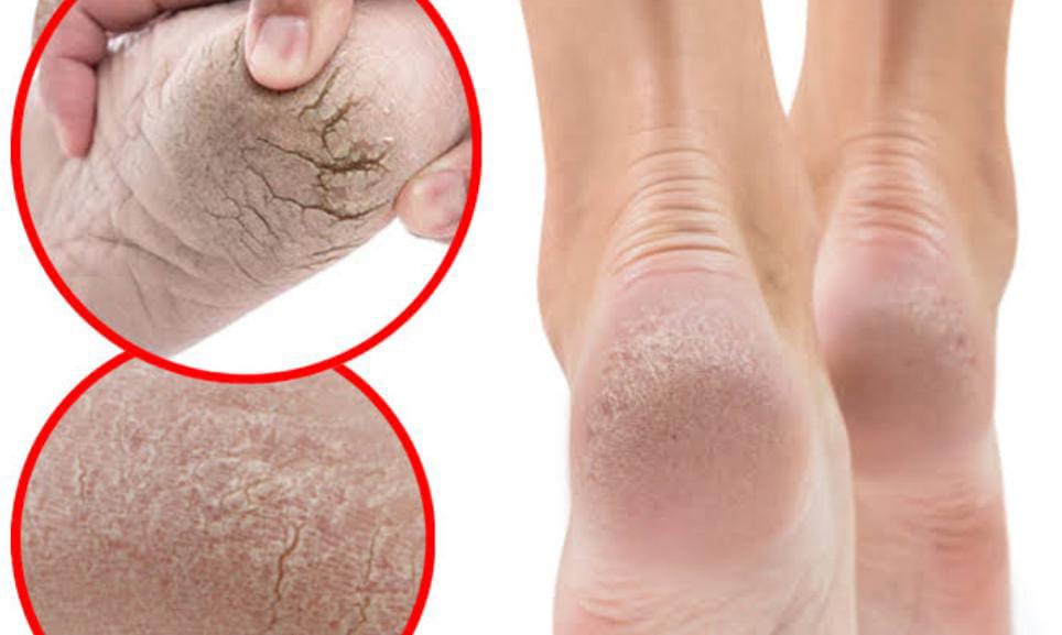 Winter Tips:सर्दियों में फटी एडियां कर रही है परेशान और शर्मिंदा, तो आज ही आजमाएं सदियों पुराना ये घरेलू नुस्खा